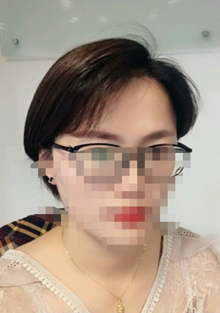 發(fā)際線植發(fā)案例