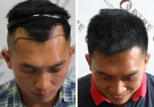 廣州新生植發(fā)貴不貴，結(jié)合真實(shí)植發(fā)案例效果分享