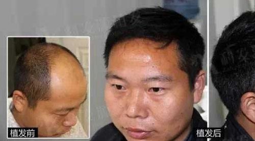 杭州新生植發(fā)醫(yī)院植發(fā)4000單位，王先生植發(fā)效果分享