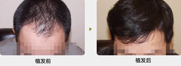 南京植發(fā)價格高嗎？李先生南京新生真實植發(fā)案例分享