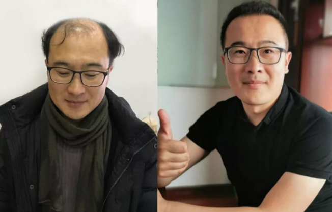 去廣州新發(fā)現(xiàn)植發(fā)貴嗎？術(shù)后效果怎么樣？