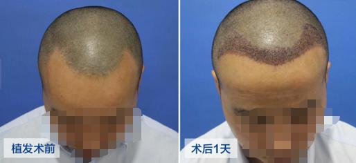 邯鄲市植發(fā)一個(gè)毛囊多少錢(qián)？術(shù)后效果看趙先生植發(fā)案例