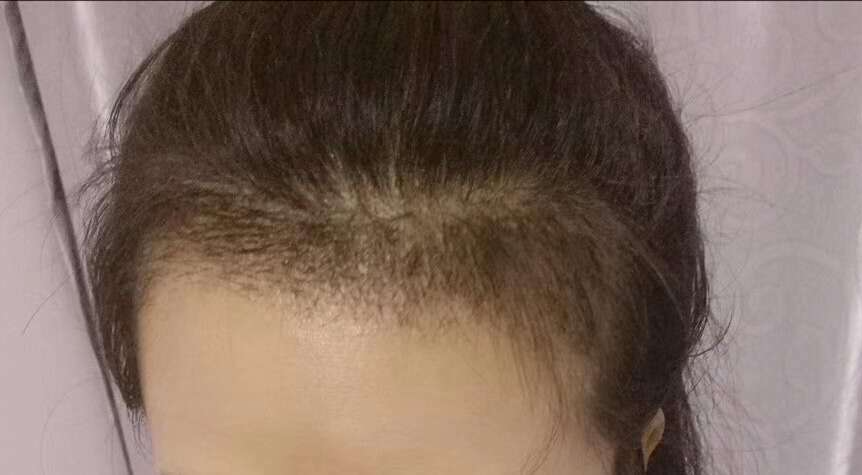 哈爾濱植發(fā)醫(yī)院排名哪家好？正規(guī)醫(yī)院植發(fā)流程是怎樣的？