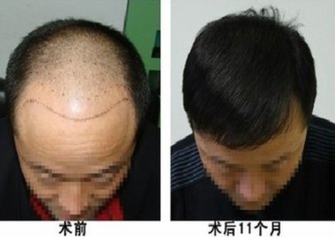 武漢植發(fā)效果怎樣？王先生真實(shí)植發(fā)案例讓你參考