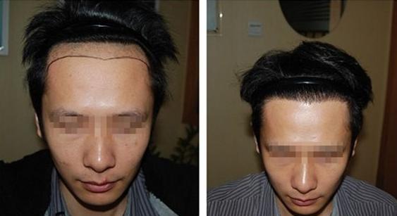 武漢新生植發(fā)2600單位案例，植發(fā)手術(shù)前后對(duì)比