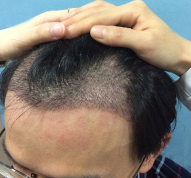 福州植發(fā)貴不貴？效果怎么樣就看劉先生真實植發(fā)案例