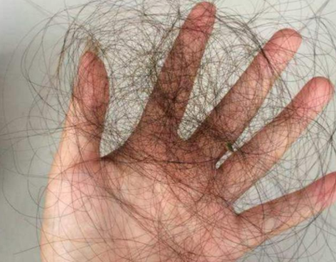 什么是植發(fā)？植發(fā)手術(shù)后頭發(fā)還會掉嗎？