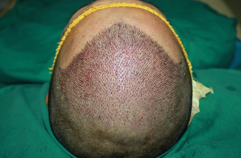 福州植發(fā)醫(yī)院排名，醫(yī)院真實(shí)植發(fā)案例分享