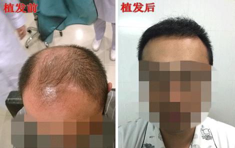 頭頂植發(fā)多少錢？楊先生五級脫發(fā)植發(fā)真實案例