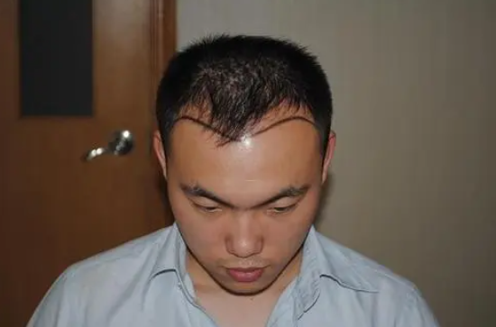 什么原因?qū)е旅摪l(fā)的呢？掉頭發(fā)可以植發(fā)嗎？