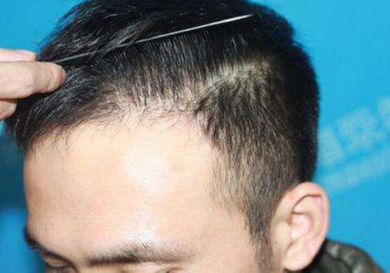 北京植發(fā)際線醫(yī)院哪家好