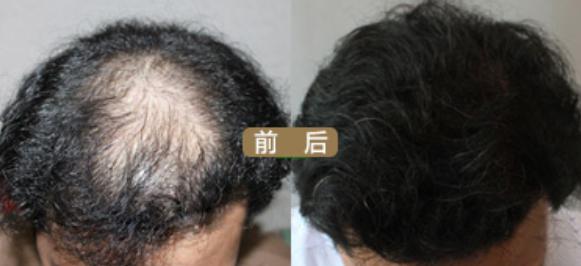 沈陽(yáng)植發(fā)費(fèi)用貴嗎？張先生沈陽(yáng)牛大夫植發(fā)案例分享