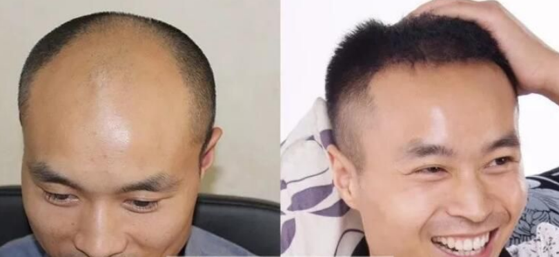 杭州植發(fā)好不好？李先生天津新生植發(fā)4000單位分享案例經驗