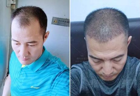 無錫植發(fā)費用高嗎？術(shù)后恢復(fù)效果怎么樣？