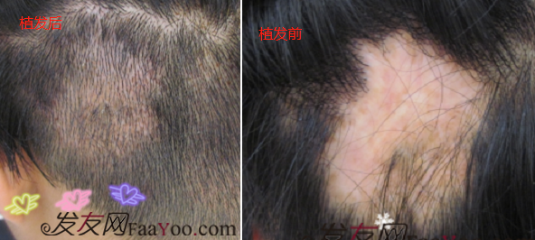 疤痕怎么辦？南昌大麥微針疤痕無痕植發(fā)1000單位案例分享