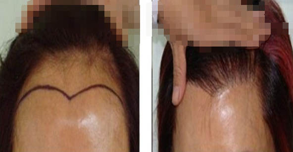 什么人不可以做植發(fā)手術(shù)？手術(shù)前需要剃頭嗎？