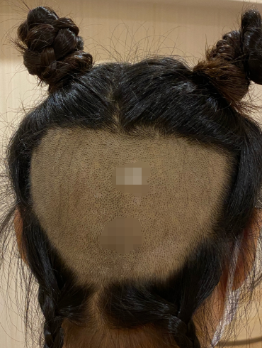 成都絲恒發(fā)際線植發(fā)1850單位案例分享，希望我的分享能幫到你