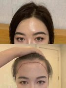 盤(pán)點(diǎn)上海九院做植發(fā)比較知名的醫(yī)生?。ǜ街舶l(fā)案例對(duì)比圖）