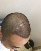 上海大麥植發(fā)和雍禾植發(fā)哪家好？（附植發(fā)案例效果圖）