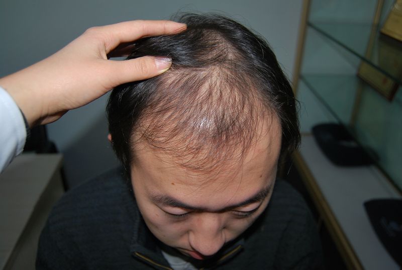 武漢專業(yè)植發(fā)醫(yī)院排名，安全靠譜的植發(fā)經歷