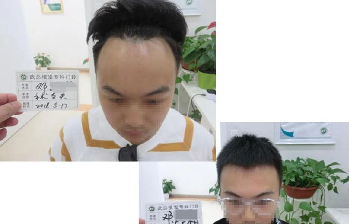 武總植發(fā)醫(yī)院技術(shù)怎么樣