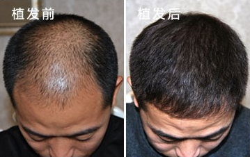 重慶仁愛植發(fā)醫(yī)院怎么樣?肖麗醫(yī)生植發(fā)好不好?