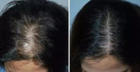 重慶新生植發(fā)靠譜嗎?附地址_劉尚彥醫(yī)生介紹_加密種植案例分享