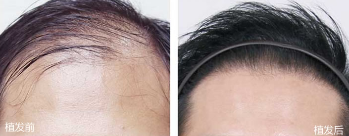 北京成好醫(yī)療美容植發(fā)醫(yī)院正規(guī)嗎?醫(yī)生介紹+植發(fā)效果