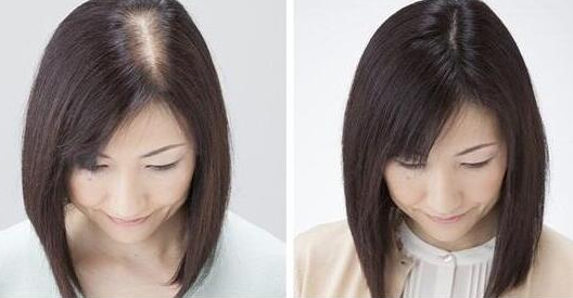 深圳倍生植發(fā)靠譜嗎?陸昌龍醫(yī)生發(fā)縫加密種植效果好嗎?