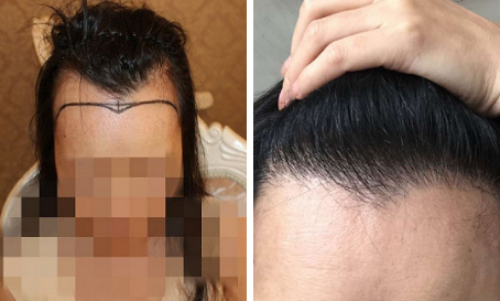 長沙植發(fā)醫(yī)院【公立】名單，植發(fā)應該掛什么科?