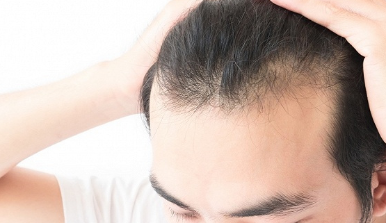天津有植發(fā)醫(yī)院嗎?天生額頭高可以做植發(fā)手術(shù)嗎?
