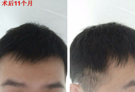 南寧碧蓮盛植發(fā)好不好?醫(yī)生介紹及植發(fā)效果案例