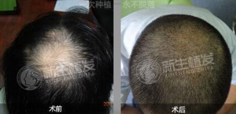 貴陽新生植發(fā)醫(yī)院靠譜嗎?醫(yī)院頭發(fā)種植效果怎么樣?附價格表