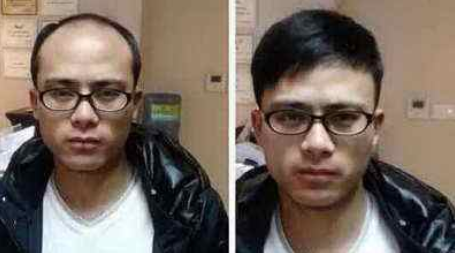 沈陽大麥微針植發(fā)醫(yī)院怎么樣?附醫(yī)院地址_醫(yī)生_禿頂植發(fā)案例_價(jià)格表