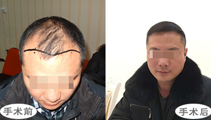 河南育發(fā)植發(fā)研究院植發(fā)手術怎么樣?附地址_醫(yī)生介紹_脫發(fā)植發(fā)案例分享