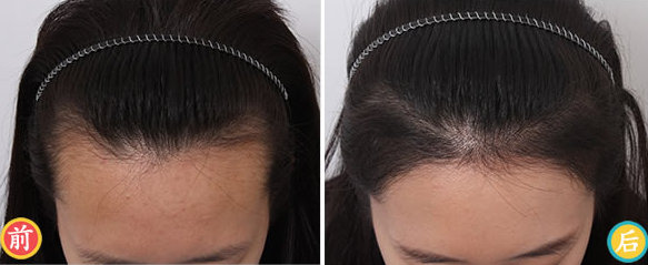 南寧植發(fā)醫(yī)院排名|哪家醫(yī)院植發(fā)好?附發(fā)際線種植效果