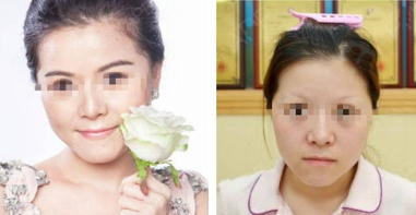 莆田新生植發(fā)醫(yī)院植發(fā)靠譜嗎?附醫(yī)院地址_眉毛種植效果