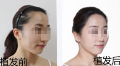 分析四川成都潤禾植發(fā)醫(yī)院怎么樣?附地址_發(fā)際線種植案例_價格表