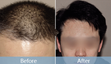 上海時光植發(fā)醫(yī)院是正規(guī)嗎?附地址_醫(yī)生介紹_植發(fā)案例_價格表