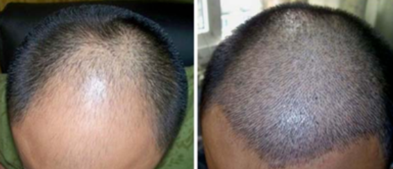 山西正規(guī)植發(fā)醫(yī)院，雍禾種植3100單位案例