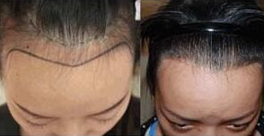 濟(jì)南植發(fā)醫(yī)院排名|濟(jì)南哪里植發(fā)技術(shù)好?價(jià)格多少?附價(jià)格表