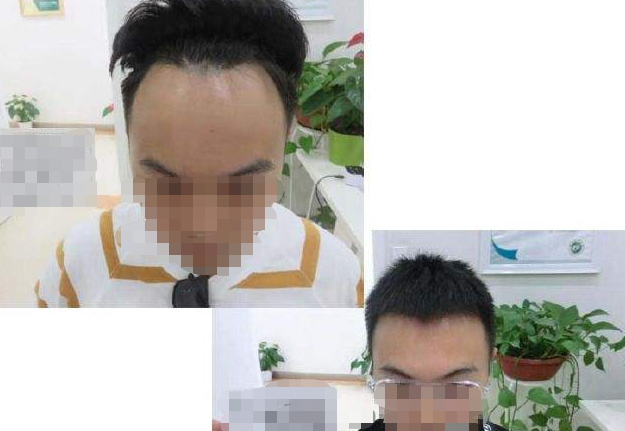 廣州青逸植發(fā)怎么樣?發(fā)際線改善效果好嗎?附何醫(yī)生介紹