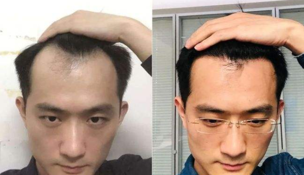 廣州倍生植發(fā)醫(yī)院靠譜嗎?植發(fā)醫(yī)生名單及價格表