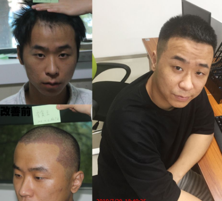 廣州華美植發(fā)中心怎么樣?植發(fā)醫(yī)生信息匯總+男性植發(fā)案例