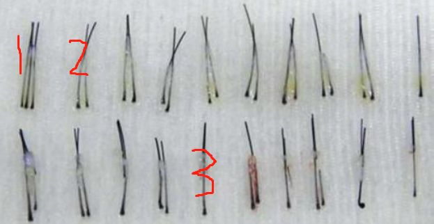 植發(fā)1000個(gè)毛囊單位需要價(jià)格多少錢(qián)？