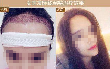 太原碧蓮盛植發(fā)醫(yī)院地址在哪?植發(fā)怎么樣?附發(fā)際線種植分享