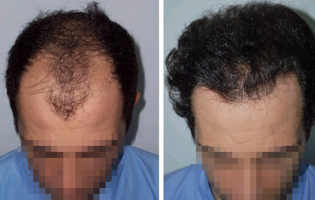 無錫百年植發(fā)好不好?頭發(fā)種植效果怎么樣?附植發(fā)價格表