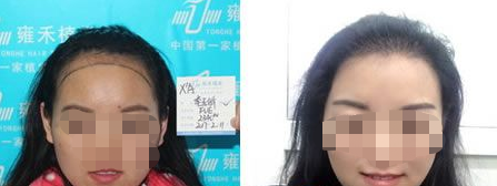 西安雍禾植發(fā)醫(yī)院怎么樣?附地址_醫(yī)生介紹_植發(fā)案例_價(jià)格表