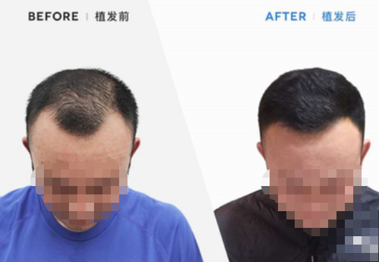 昆明新生植發(fā)怎么樣?附地址_王醫(yī)生介紹_植發(fā)際線案例效果