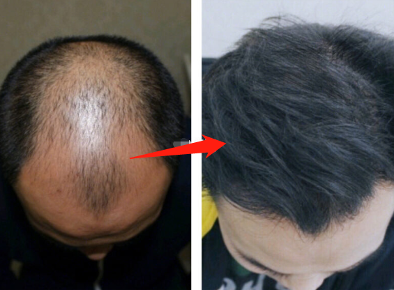 福州雍禾植發(fā)怎么樣?好不好?附醫(yī)院植發(fā)效果及價(jià)目表分享